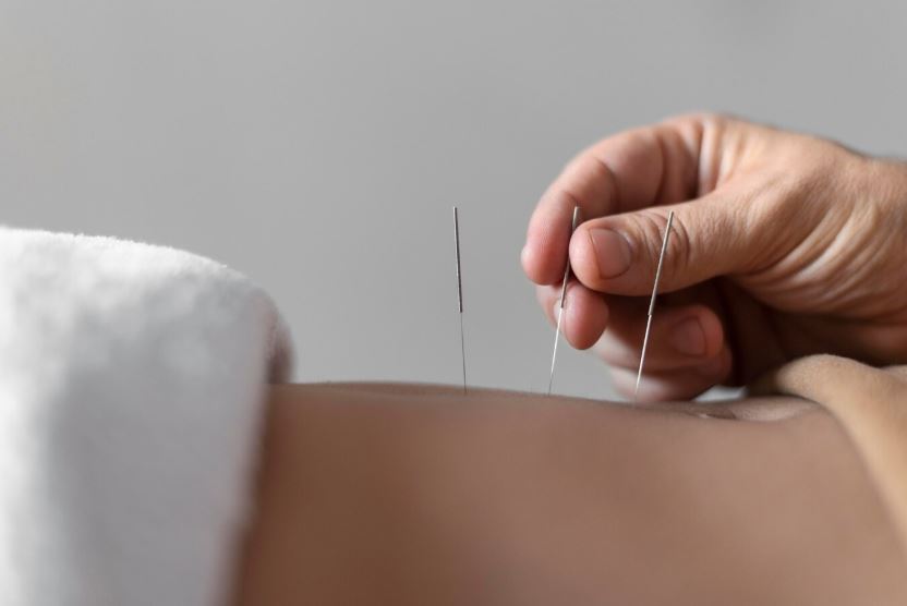 Acupuncture